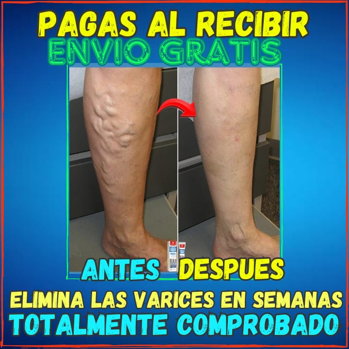 ✅Elimina tus Varices en Semanas😱, Crema Varicos Con Efecto Intravascular (💥Pagas al Recibirlo💥)