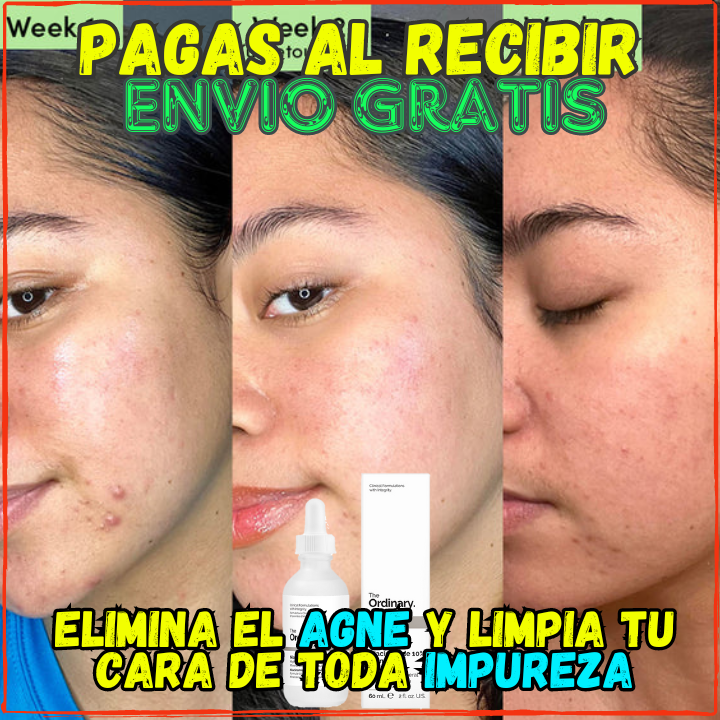 ✅Elimina el Agne, Espinillas y Porocidades En Poco tiempo😉, Ideal para tener un Rostro Limpio y Libre de Manchas(💥Pagas al Recibirlo💥)