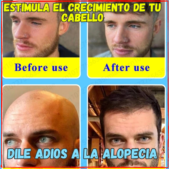 ✅Has que tu Pelo Vuelva a Crecer en 3 Meses😱, Locion Para Alopecia Para Hombre y Mujer(💥Pagas al Recibirlo💥)