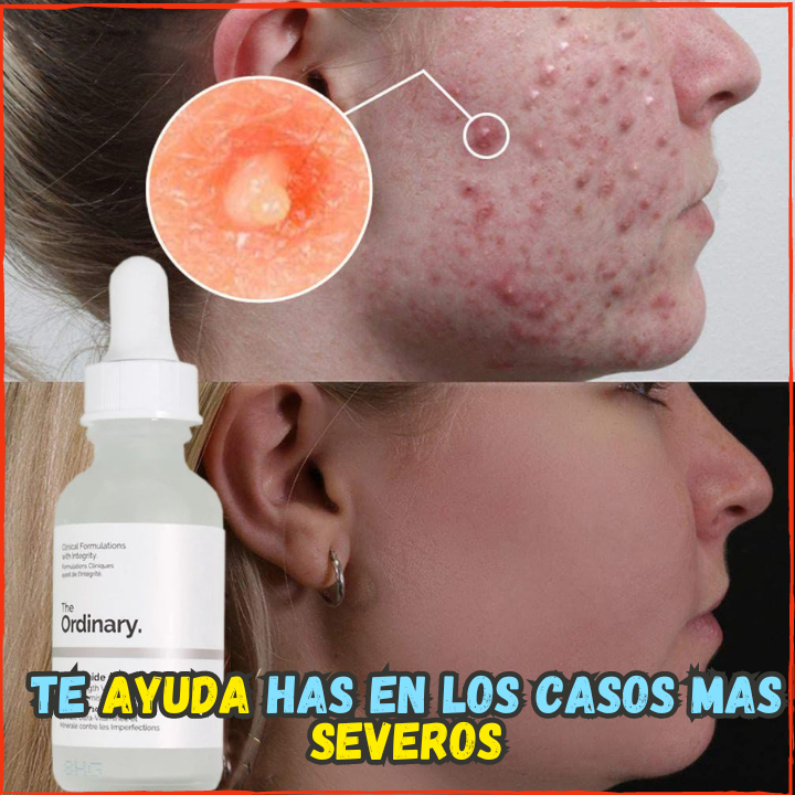 ✅Elimina el Agne, Espinillas y Porocidades En Poco tiempo😉, Ideal para tener un Rostro Limpio y Libre de Manchas(💥Pagas al Recibirlo💥)