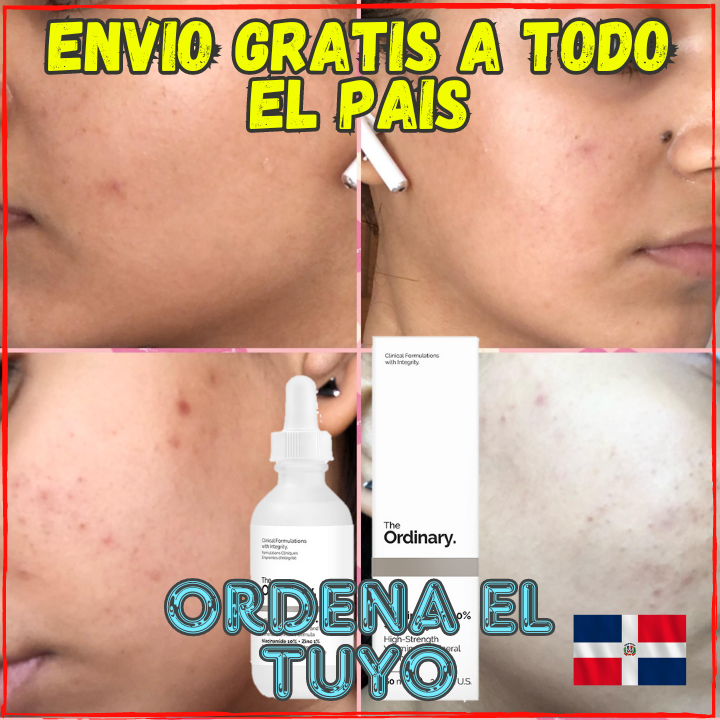 ✅Elimina el Agne, Espinillas y Porocidades En Poco tiempo😉, Ideal para tener un Rostro Limpio y Libre de Manchas(💥Pagas al Recibirlo💥)