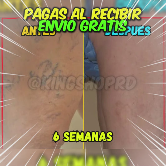 ✅Elimina tus Varices en Semanas😱, Crema Varicos Con Efecto Intravascular (💥Pagas al Recibirlo💥)